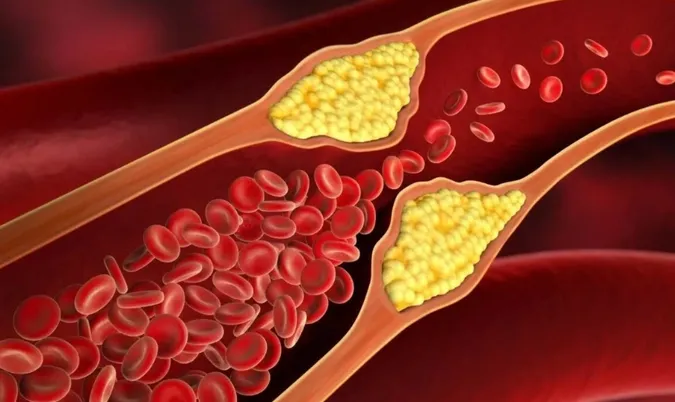Atorvastatine: pourquoi est-elle prescrite ?