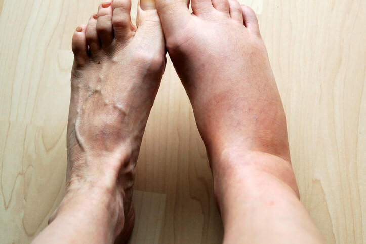 œdèmes périphériques